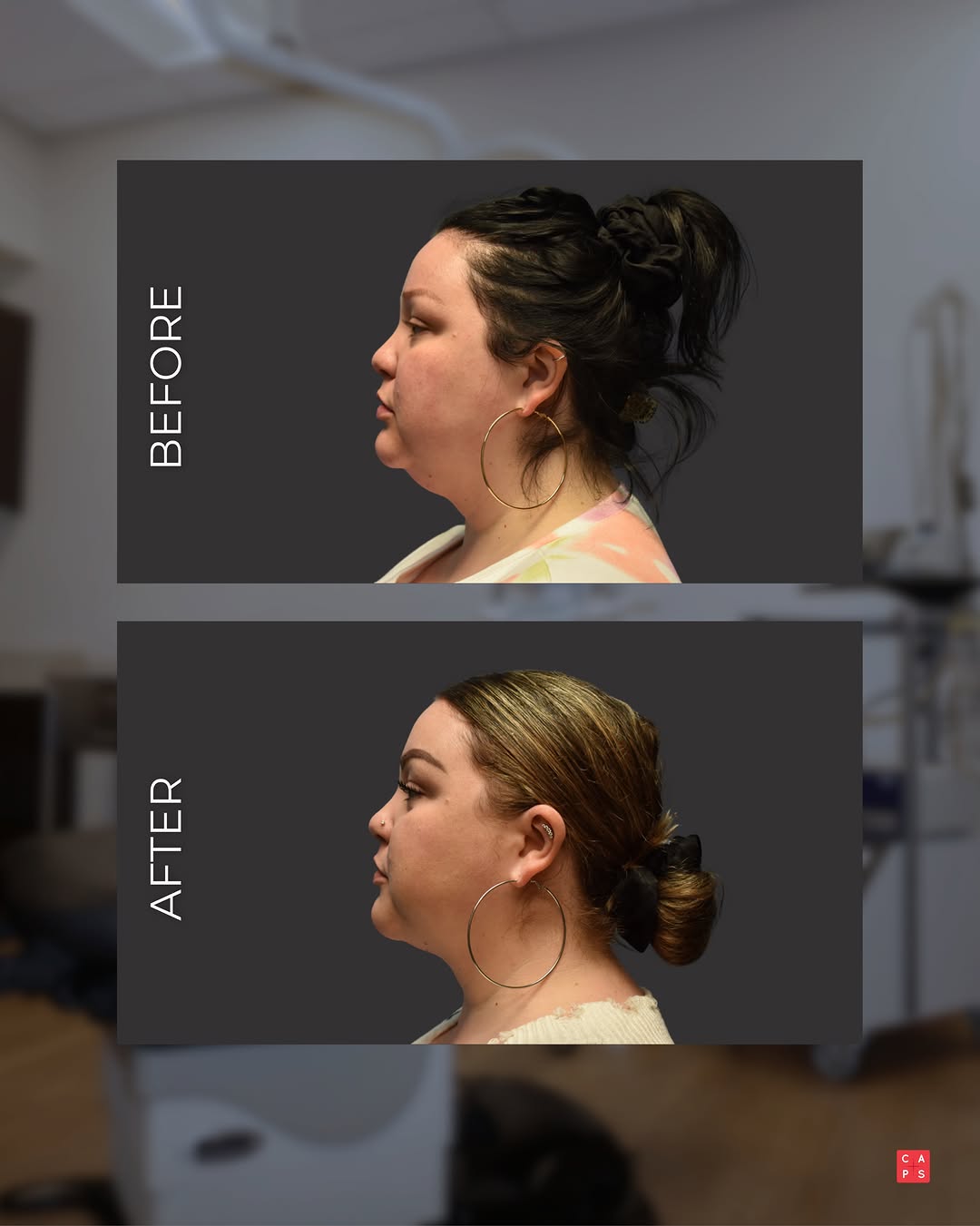 Instagram post by Dr. Tyler Sbrocchi: Thinking about liposuction? Start with a conversation. Liposuction can help refine and reshape areas of the body where stubborn pockets of f…