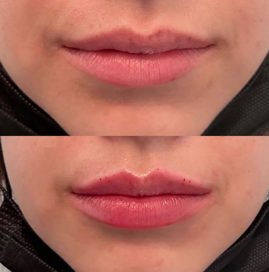 Instagram post by Dr. Tyler Sbrocchi: the difference is in the shape. more definition through the upper lip, a cleaner cupid’s bow, and just enough volume to make everything read…
