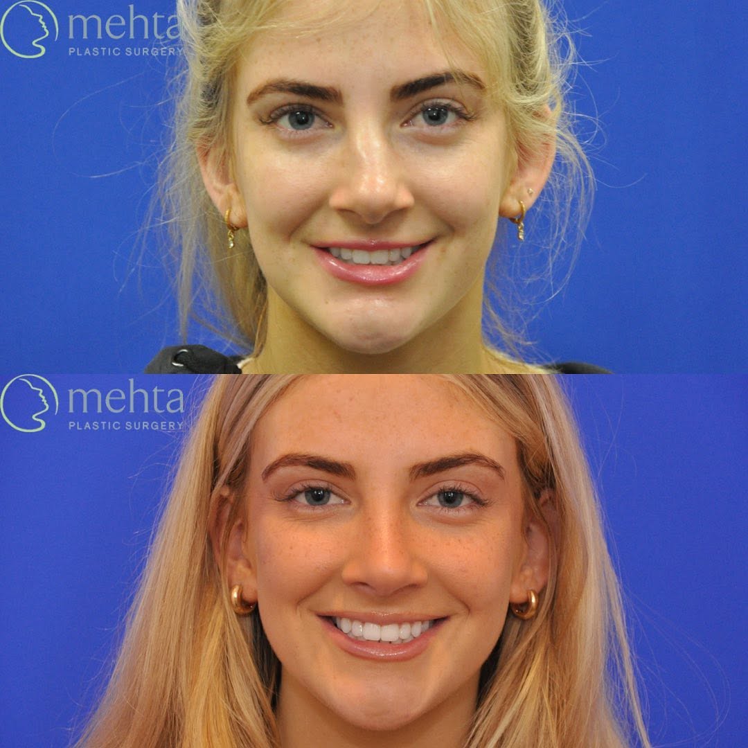 Instagram post by Dr. Umang Mehta: This 18 year old patient is so happy with her results 8 months after open rhinoplasty and septoplasty! She had fractured her nose in a water…