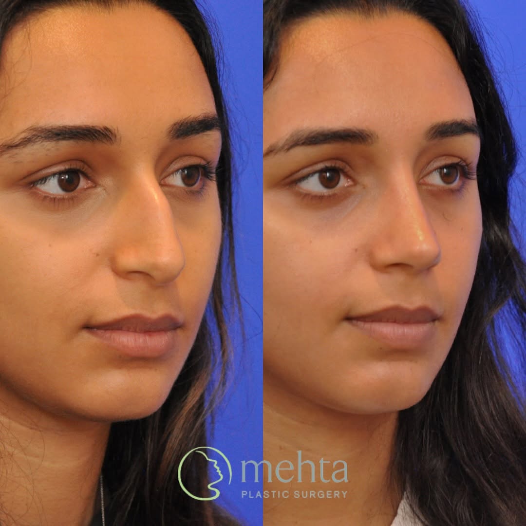 Instagram post by Dr. Umang Mehta: We are so proud to share today’s patient, 7 months after open rhinoplasty and septoplasty with Dr. Mehta! Her new nose beautifully complemen…