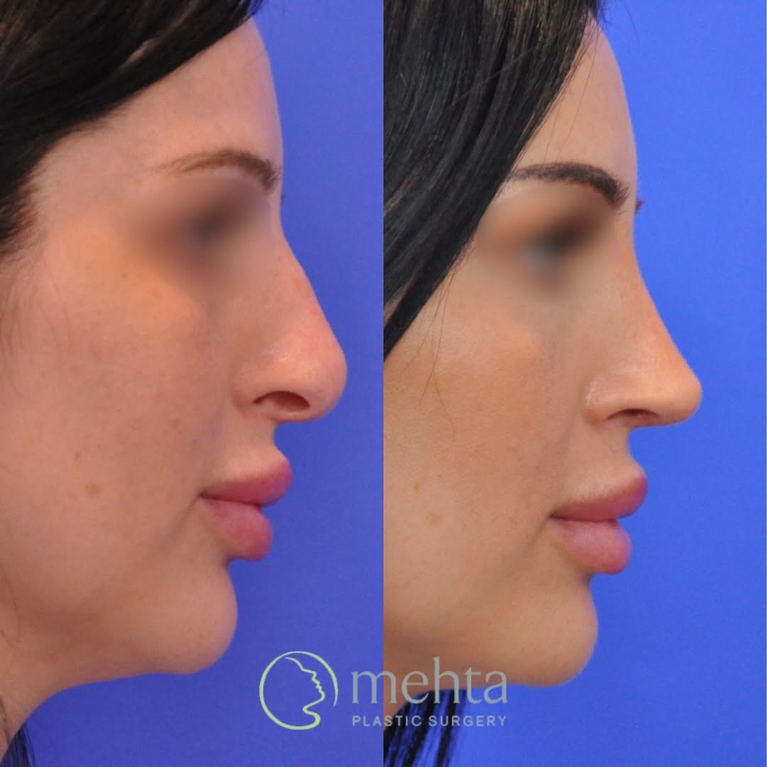 Instagram post by Dr. Umang Mehta: Refined from every angle✨ Only three months post-op!?! Today’s featured patient underwent an open rhinoplasty and septoplasty to address bot…