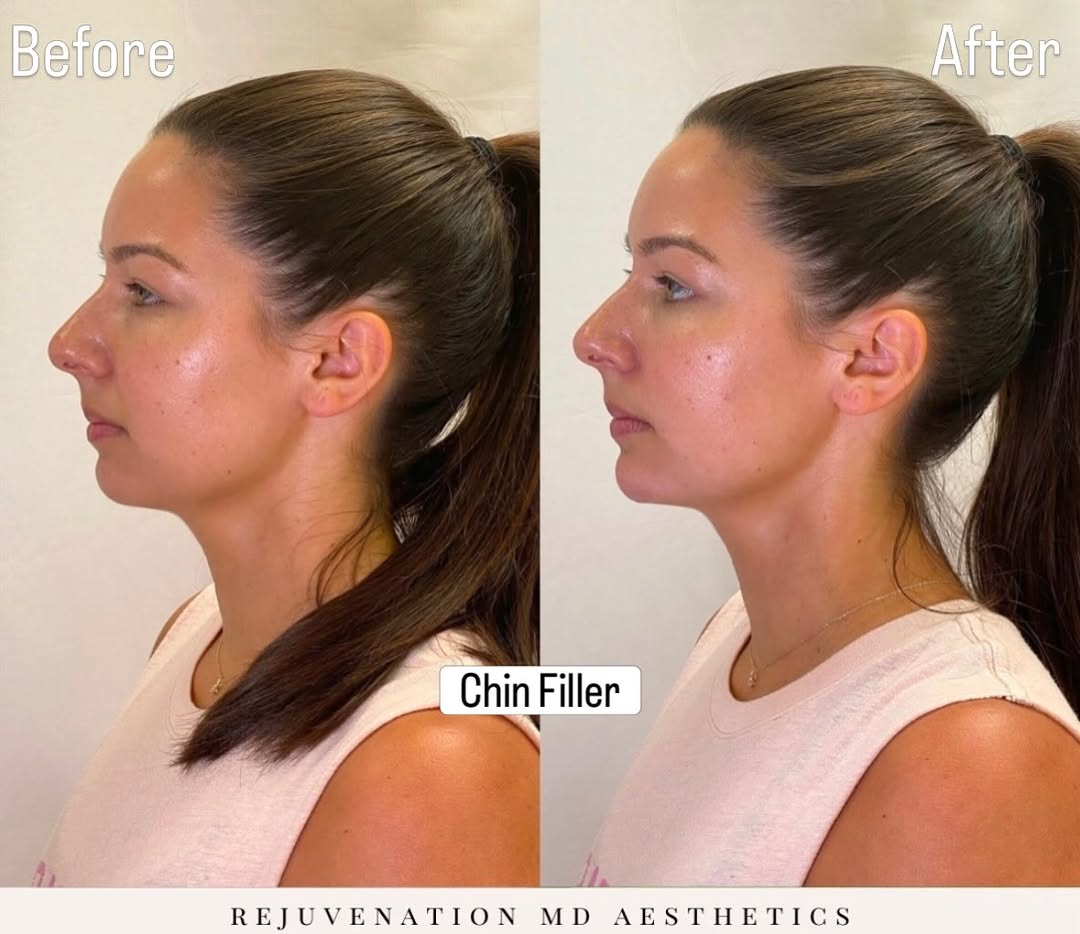 Instagram post by Dr. Umbreen Chaudhary: Fall bridal season is here💫 and sometimes the smallest adjustments can make the biggest difference in photos. For this bride, chin filler w…