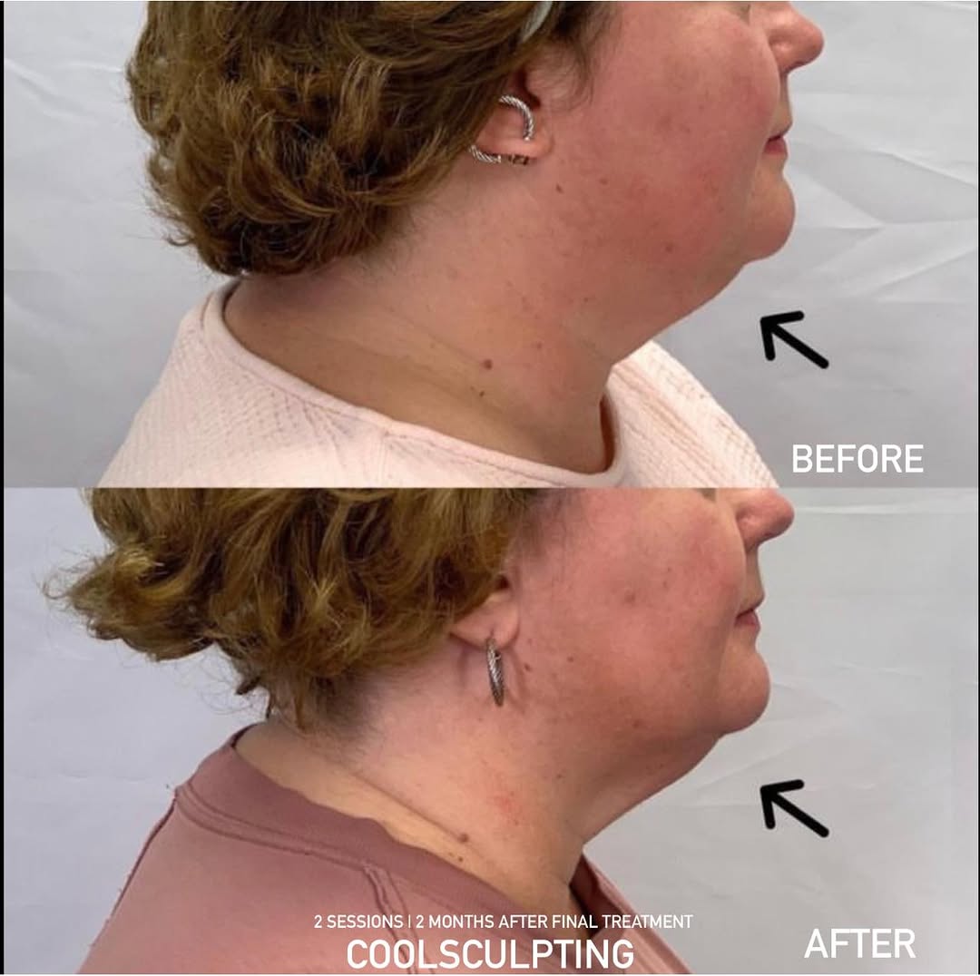 Instagram post by Dr. Umbreen Chaudhary: This patient’s main concern was fullness under the chin. We treated the area from the jawline through the neck with 2 CoolSculpting sessions…