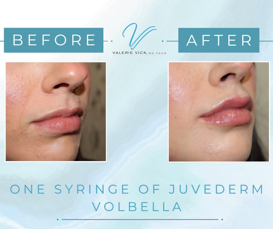 Instagram post by Dr. Valerie Vick: One syringe of Juvéderm Volbella was used to enhance the lips while maintaining a natural look. Volbella can help add subtle volume and defi…