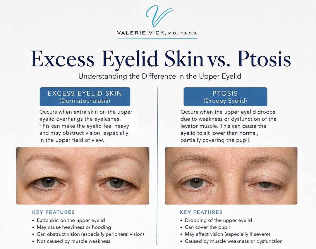 Instagram post by Dr. Valerie Vick: Excess eyelid skin and ptosis can look similar, but they are two different conditions. Excess eyelid skin occurs when extra skin on the uppe…