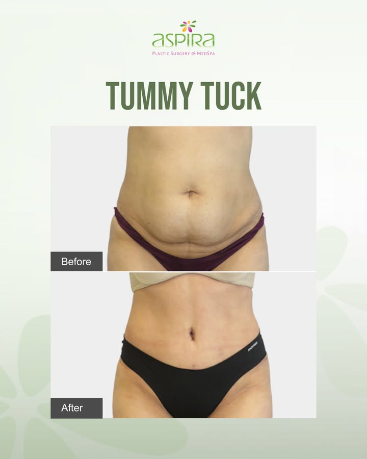 Instagram post by Dr. Ven Erella: This patient wanted to address excess abdominal skin and achieve a smoother, more contoured midsection after changes to her body. With a per…