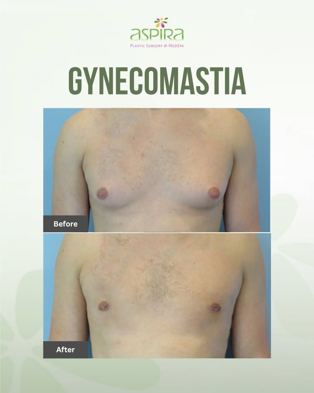Instagram post by Dr. Ven Erella: A more defined chest can make a meaningful difference in how you feel about yourself. This patient underwent Gynecomastia Surgery by Dr. Ere…