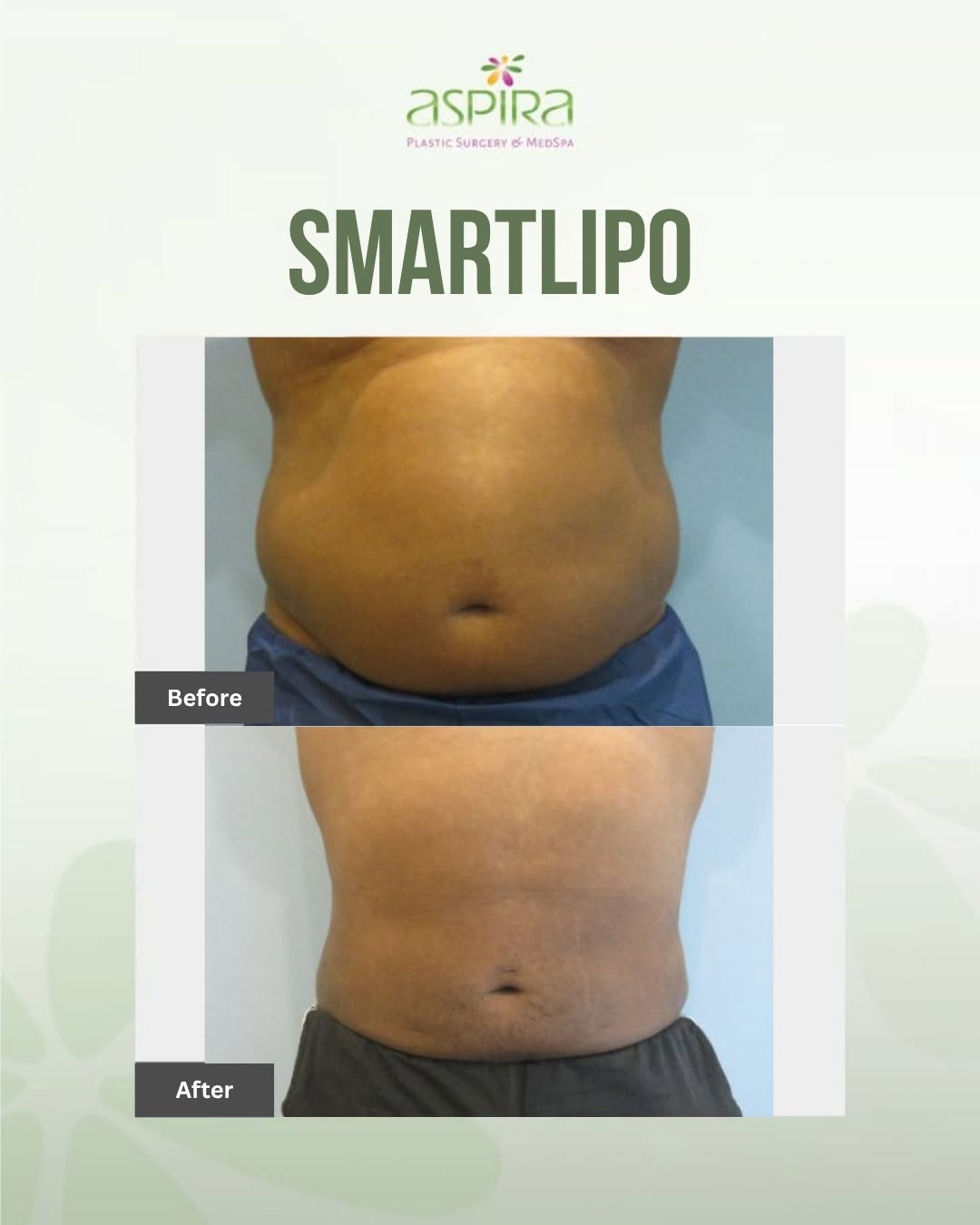Instagram post by Dr. Ven Erella: Sometimes, stubborn abdominal fat can be resistant to even your best efforts. For this patient, the focus was improving the appearance of th…