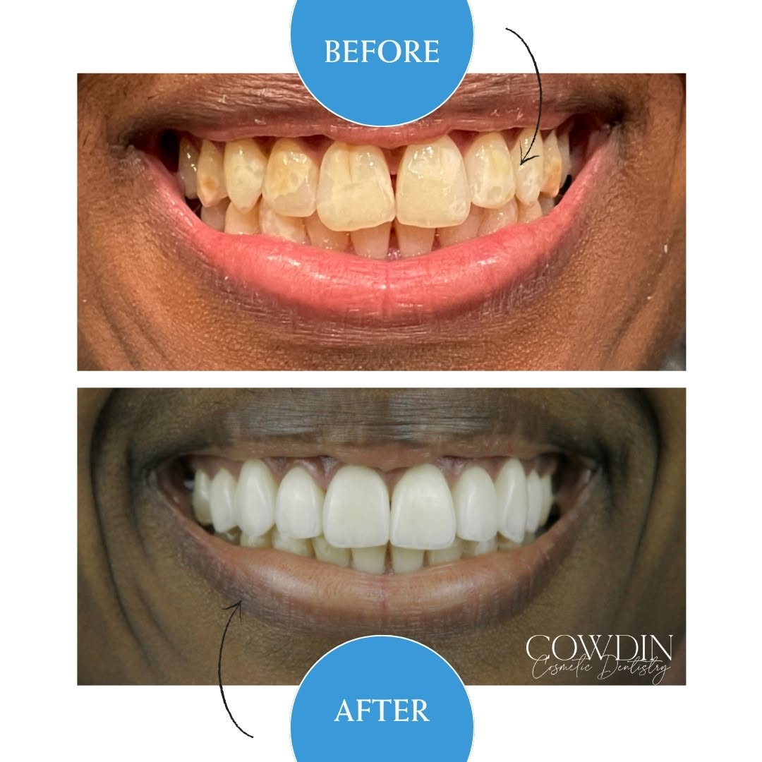 Instagram post by Dr. Vicki Borowski: Porcelain veneers are a solution for multiple cosmetic concerns. They are one of the most versatile treatments in cosmetic dentistry. These …