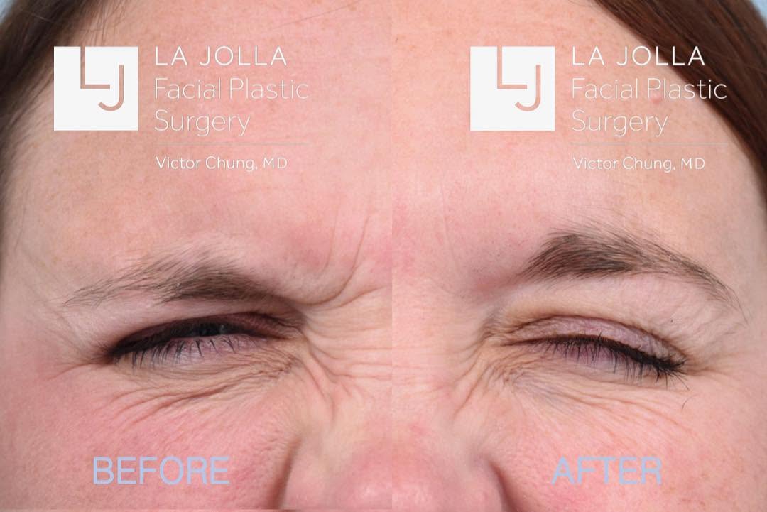Instagram post by Dr. Victor Chung: 💉 Dr. Chung performs a painless injection of #botox from #allergan to improve the crow's feet and frown lines for a more rested look #happy…
