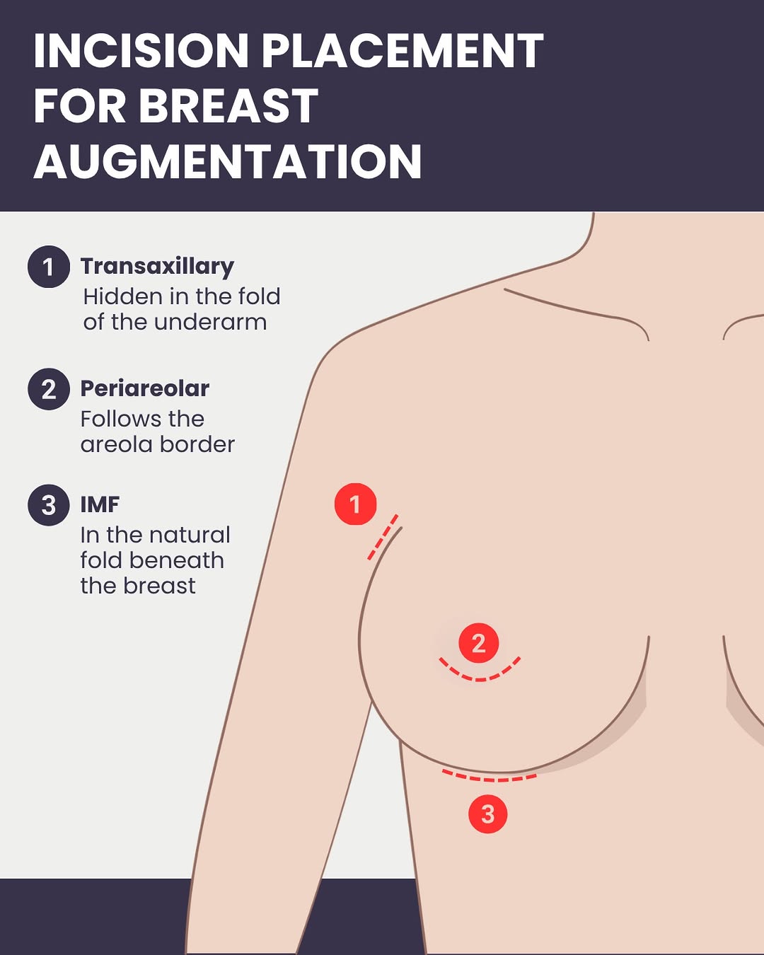 Instagram post by Dr. Victor Ferrari: Breast Augmentation Incisions: Which One Is Right for You? There are three common incision options for breast augmentation, and each has its…