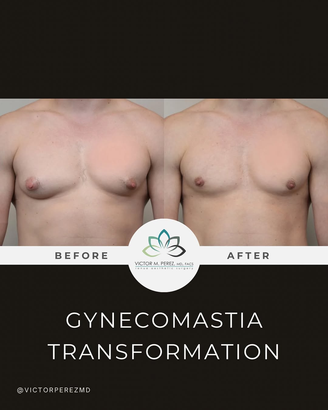 Instagram post by Dr. Victor M. Perez: Gynecomastia can cause excess breast tissue in men, creating a fuller chest appearance that may not improve with diet and exercise alone. Dr…