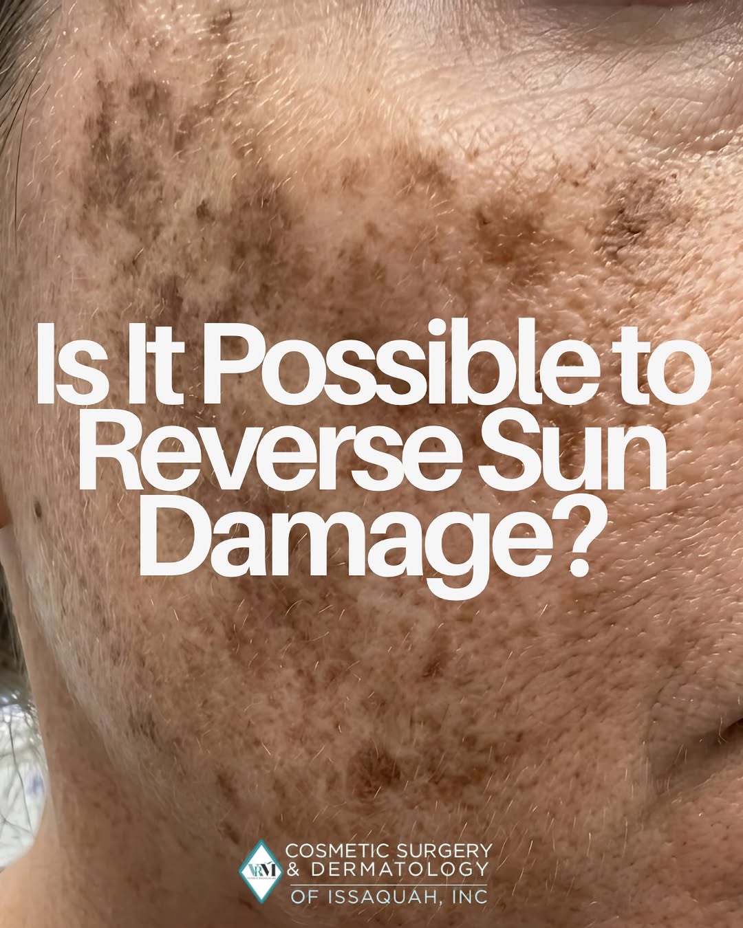 Instagram post by Dr. Victor Michalak: The good news is yes, you can reverse sun damage, but with a caveat. How to do it is a wildly deep subject because there are a lot of variab…
