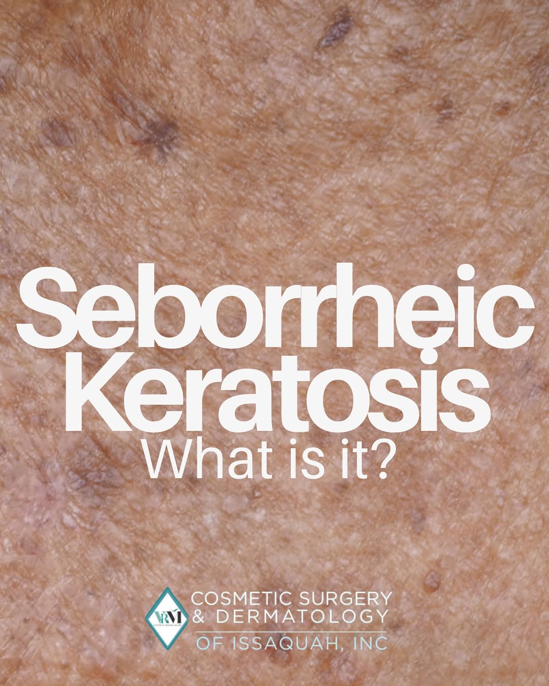 Instagram post by Dr. Victor Michalak: Seeing “barnacles” on your skin? It could be seborrheic keratosis. These are growths that start appearing on your skin as you get older. 😞 …