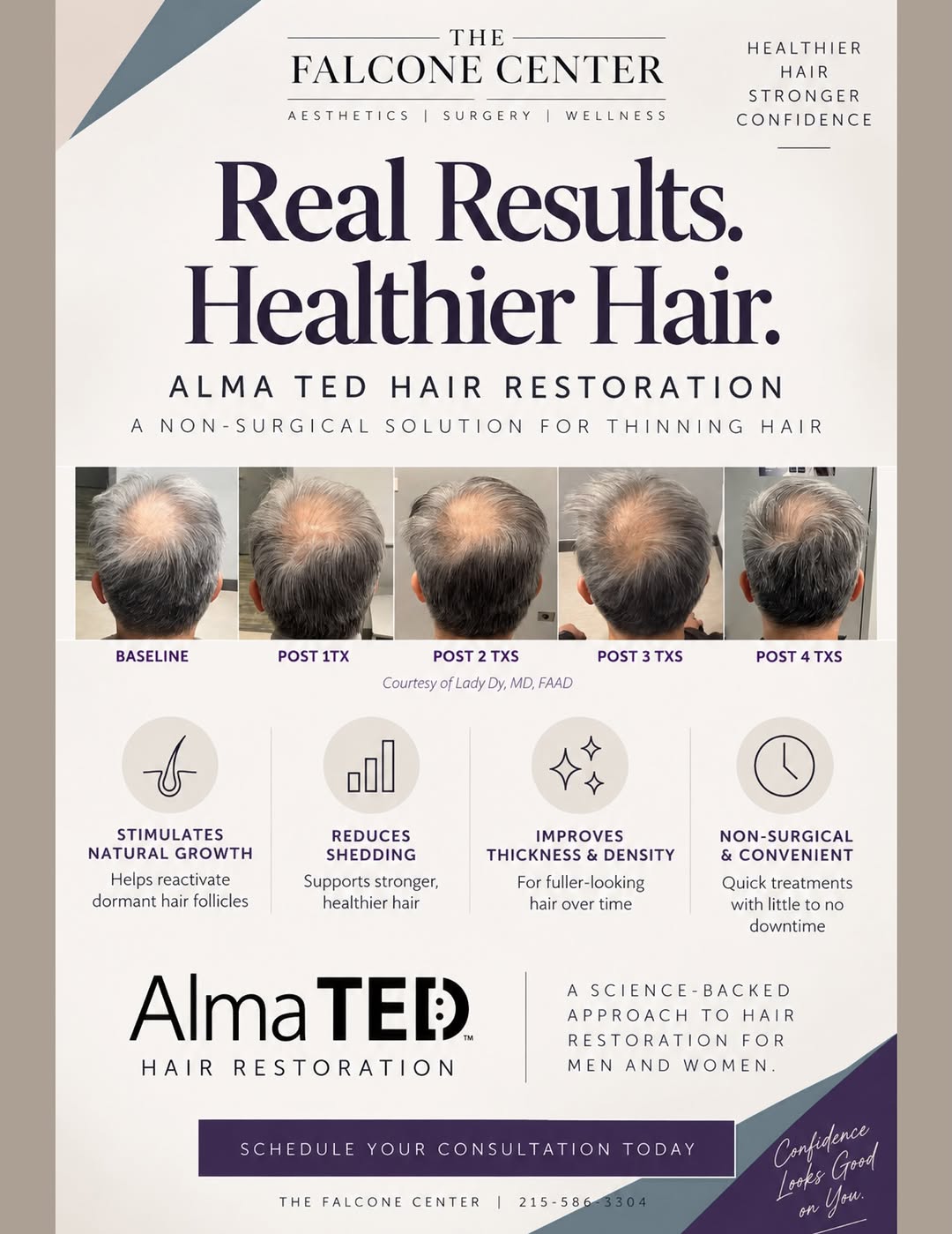 Instagram post by Dr. Victoria Falcone, DO: ✨ Stronger-Looking Hair Starts Here ✨ Discover Alma TED Hair Rejuvenation — an innovative, non-invasive treatment designed to support health…