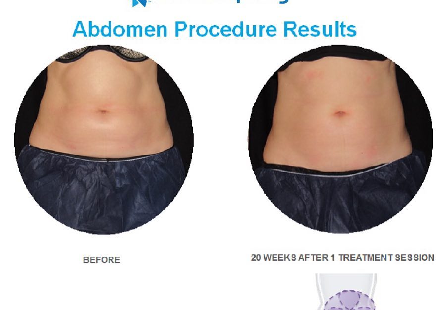 Instagram post by Dr. Vincent D. DiNick, D: Why wait for #TransformationTuesday when it’s #MakeoverMonday! This particular patient is 20 weeks out after one treatment cycle with Coolsc…