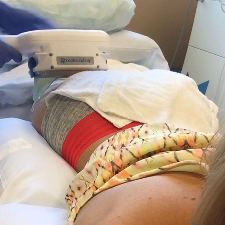 Instagram post by Dr. Vincent D. DiNick, D: Yesterday we Coolsculpted this patients “banana roll” 🍌🍌🍌. For those of you wondering what that is, it’s the area underneath your glutes.…