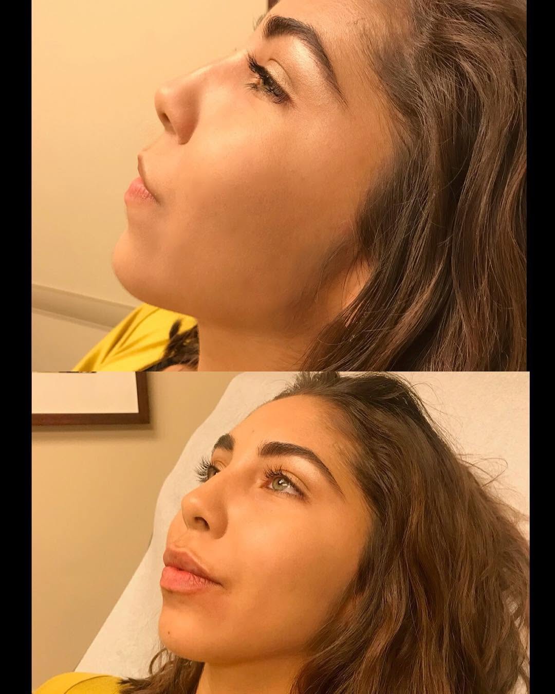 Instagram post by Dr. Vincent D. DiNick, D: Check out these before and after photos from today! Dr. DiNick and staff had SO much fun treating this patient. She was seeking more volume …