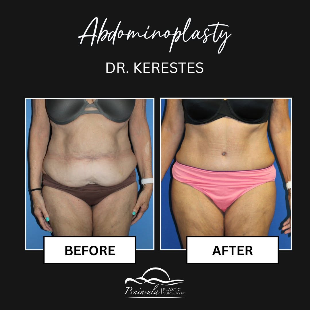 Instagram post by Dr. Vincent J. Perrotta: Planning your surgery for the fall or winter gives you plenty of time to heal and enjoy your results. An abdominoplasty (tummy tuck) removes…