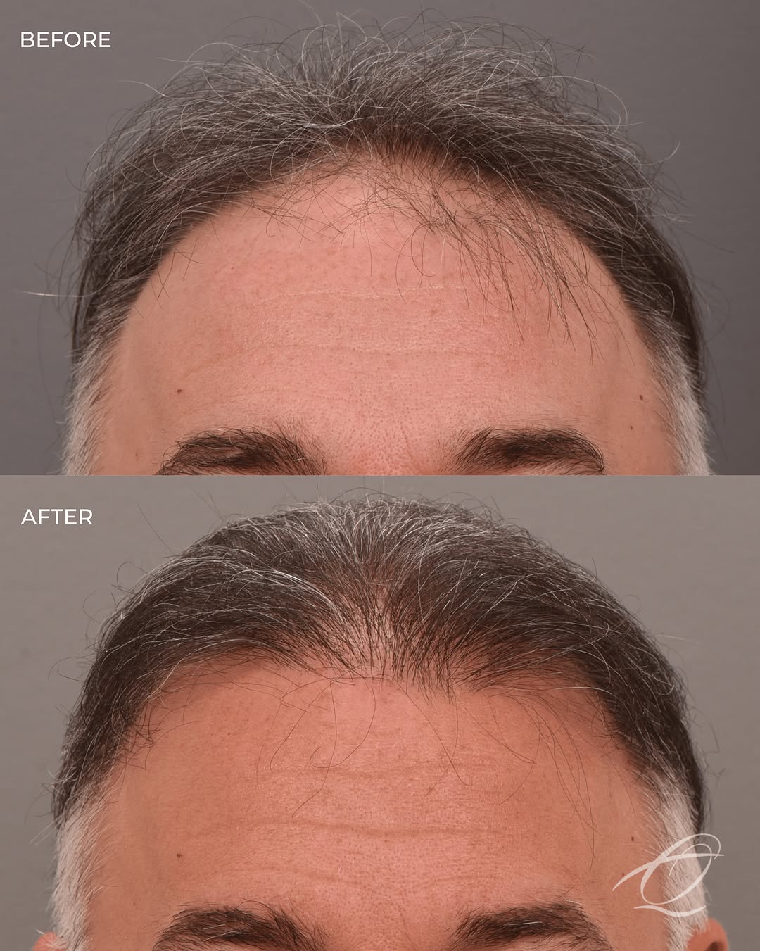 Instagram post by Dr. Vito C. Quatela: When a hair transplant is done correctly, it shouldn’t look like you had a hair transplant. That starts with the design of the hairline. The…