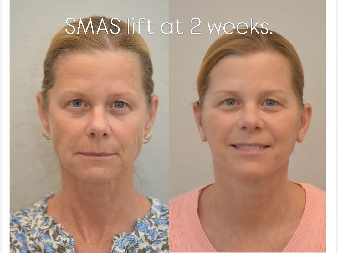 Instagram post by Dr. Vivian Ting: Give me a good SMAS lift any day for the majority of patients. In the right hands it produces beautiful and long-lasting beauty. Thank you t…