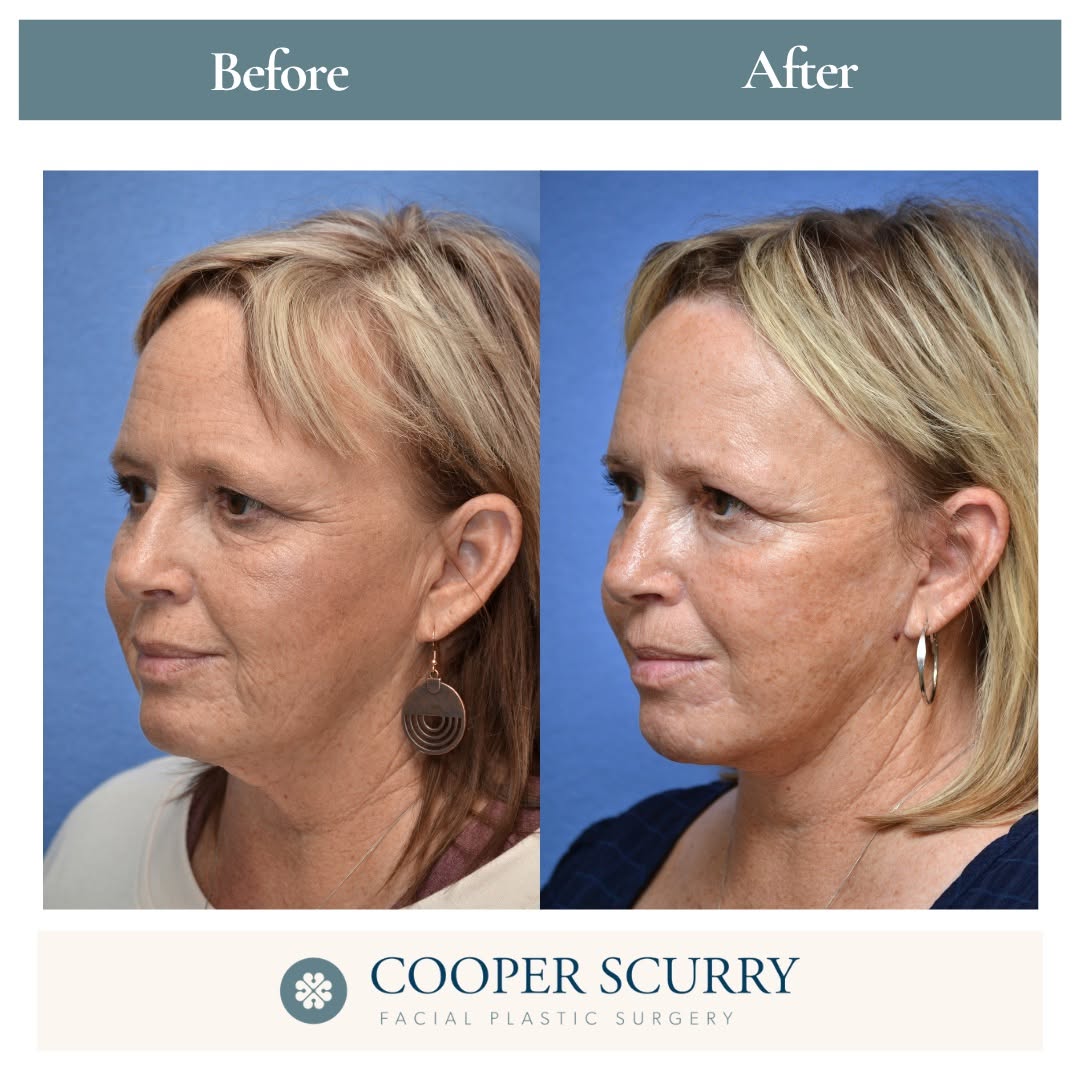 Instagram post by Dr. W. Cooper Scurry Jr.: Deep plane facelift + brow lift + CO₂ resurfacing. This combination procedure was addressing structure, position, and skin quality for a mor…