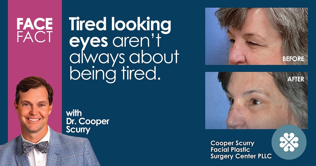 Instagram post by Dr. W. Cooper Scurry Jr.: Excess upper eyelid skin can make the eyes look heavier, hooded or fatigued. Upper blepharoplasty can create a more open, refreshed appearan…
