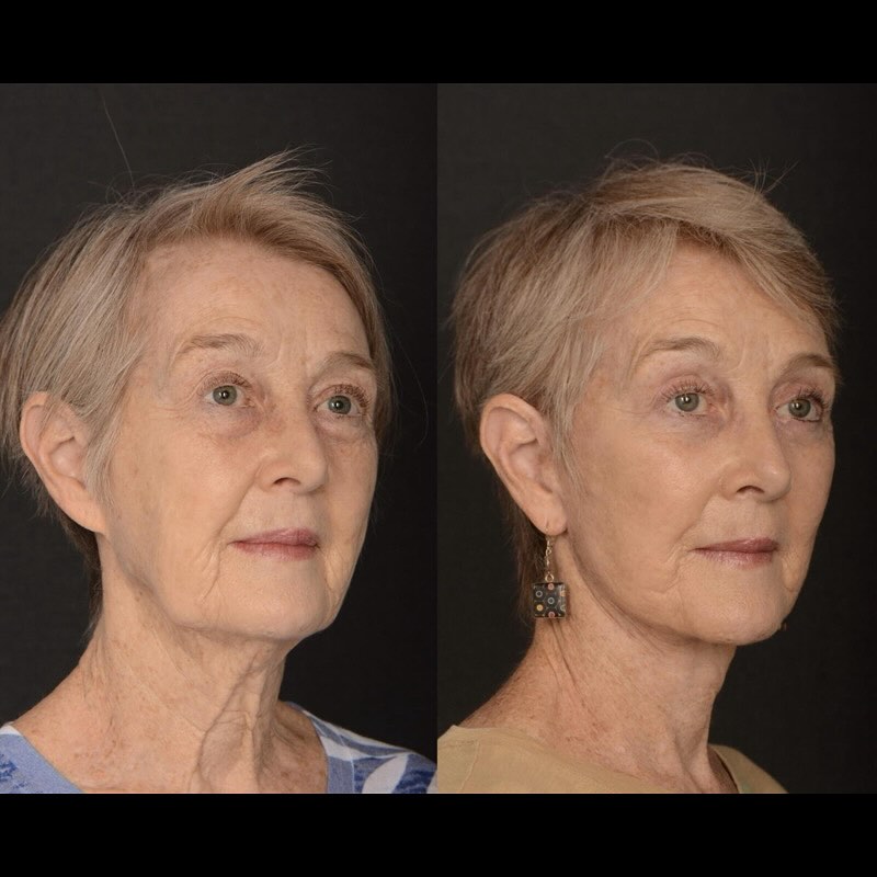 Instagram post by Dr. W. Matthew White: I’m thrilled to share this patient’s six-month post-op photos! When she came to me looking for a way to rejuvenate her face without looking …