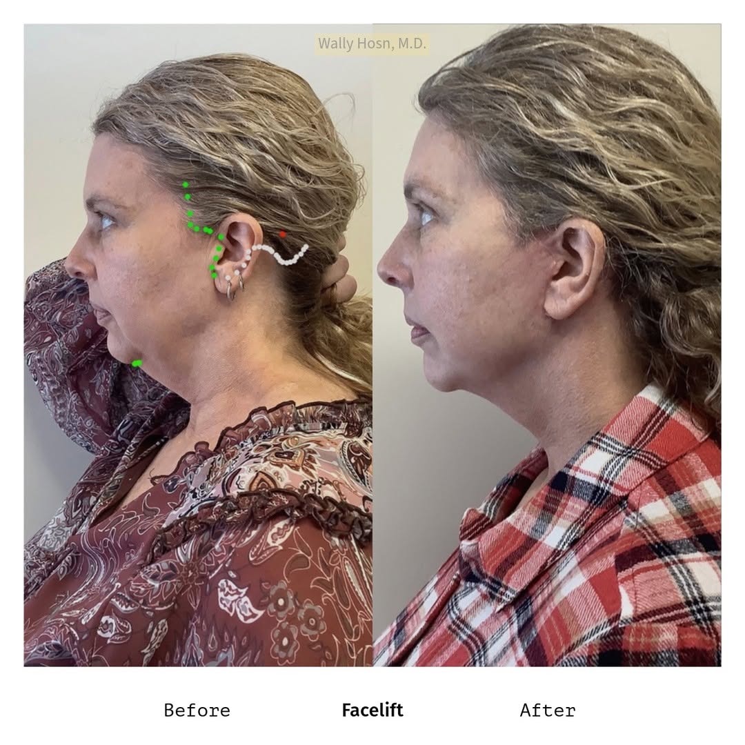 Instagram post by Dr. Wally Hosn: A recent facelift result showing the planned markings next to the final outcome. This patient wanted a tighter jawline and smoother neck. Gr…