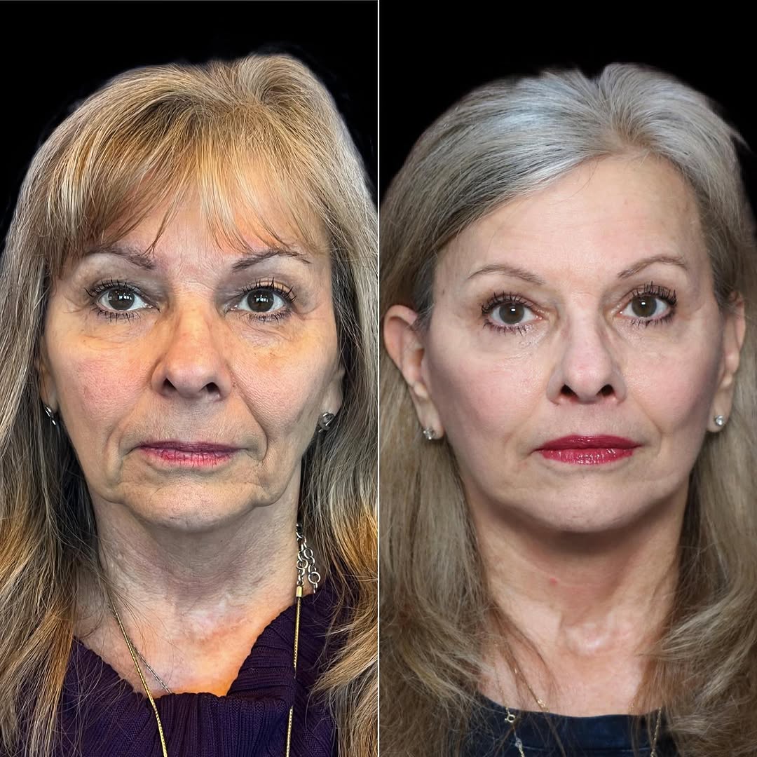 Instagram post by Dr. Walter Joseph: MOTHER/DAUGHTER??!! 🤔 Nope—just a beautiful, natural, extended deep-plane face and neck lift, lip lift, and upper eyelid lift (blepharoplas…