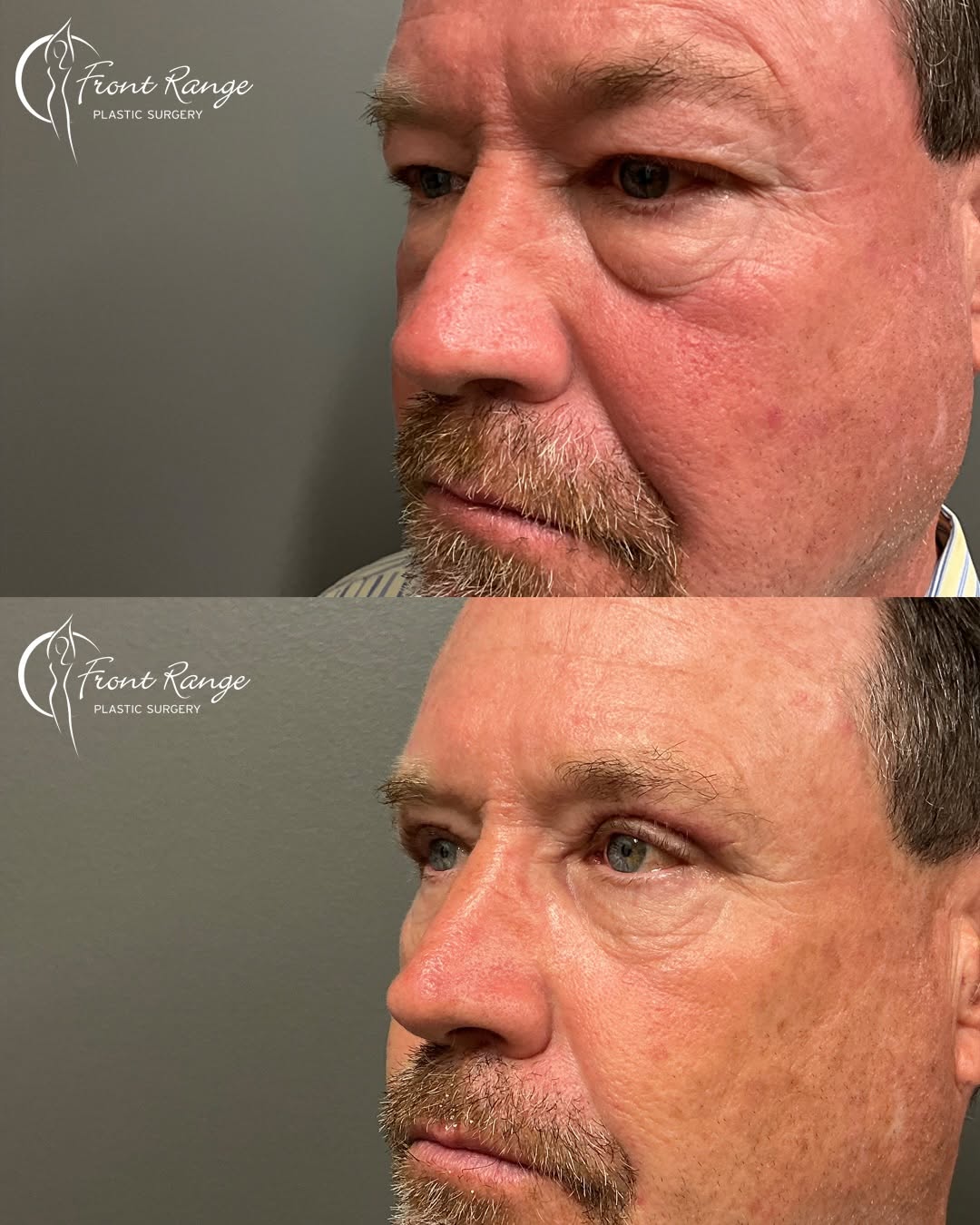 Instagram post by Dr. Warren Schutte: Before & After Upper & Lower Eyelid Surgery!👀🎉 This patient underwent both an upper blepharoplasty and lower blepharoplasty and has such a…