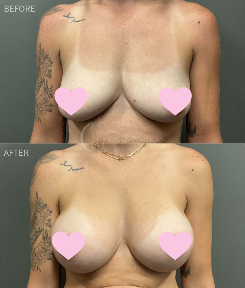 Instagram post by Dr. Warren Schutte: #Transformationtuesday Before & After!✨ 💉Procedure: Breast Augmentation 💕Implants: Mentor 500cc High Profile Silicone Filled ❌Restrictions…