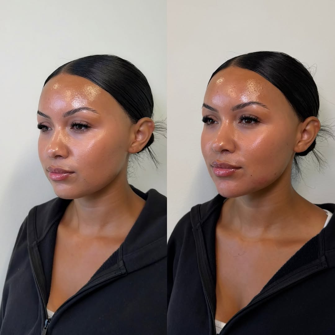 Instagram post by Dr. Wayne F. Larrabee: Lower face proportions matter, especially when you have lip filler. We treated chin + chin shadow + anterior jaw to create this seamless tra…