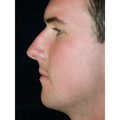 Instagram post by Dr. Wayne Foster: Did you know? Dr. Foster has spent nearly 30 years specializing exclusively in facial procedures. With thousands of rhinoplasty surgeries pe…