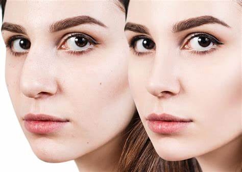 Instagram post by Dr. Wayne Foster: RHINOPLASTY FACT Did you know that your nose can keep changing shape for up to a year after rhinoplasty? Even after the initial swelling goe…