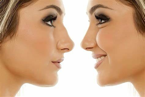 Instagram post by Dr. Wayne Foster: Choosing the Right Surgeon for Your Rhinoplasty Matters — A Lot. Your nose sits at the center of your face — so trust it to someone who spec…
