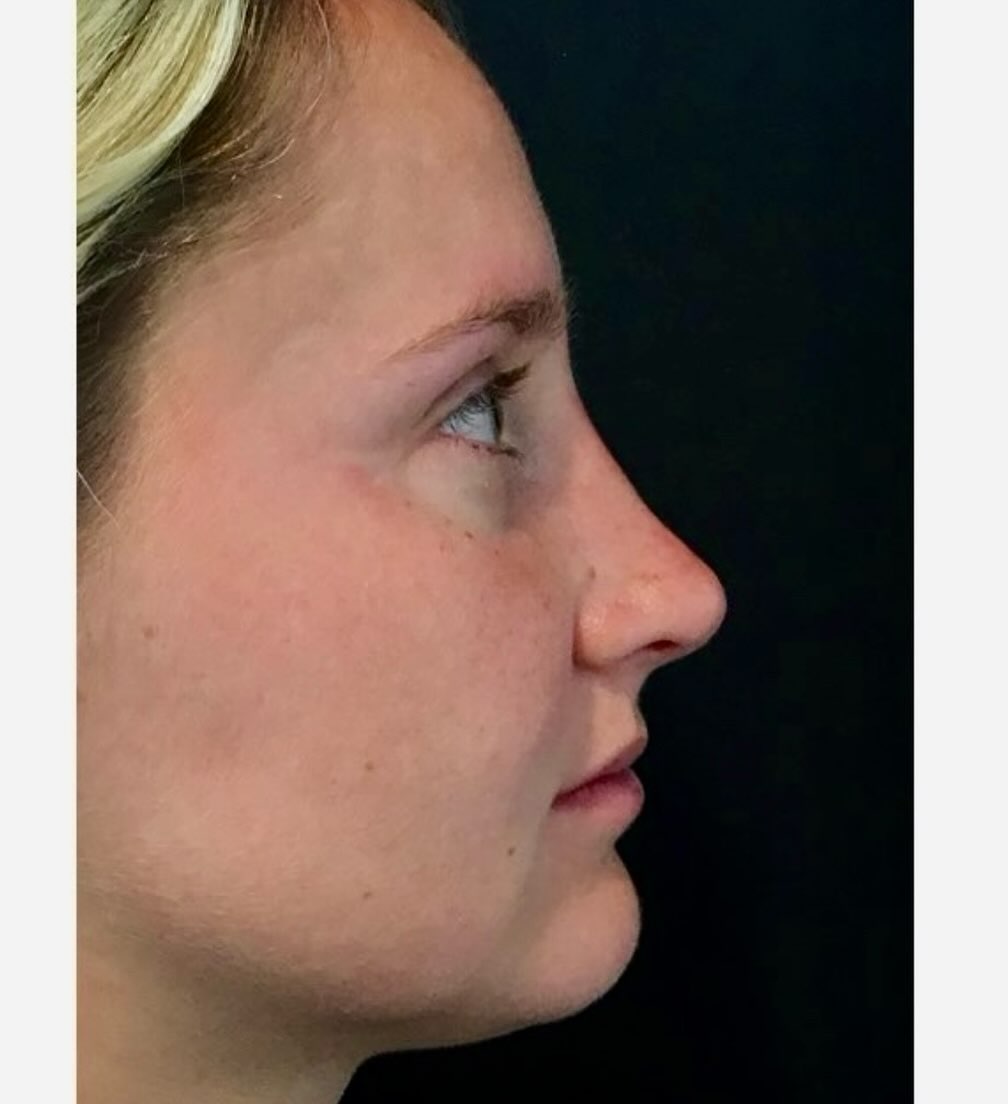 Instagram post by Dr. Wayne Foster: ✨ A profile worth a second look. ✨ Rhinoplasty is more than just refining the nose—it’s about creating balance and harmony with your natural…