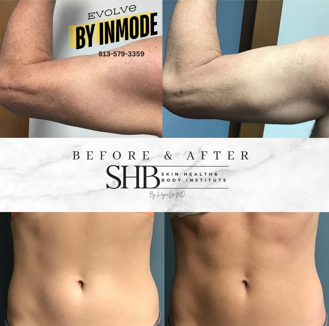 Instagram post by Dr. Wayne Lee: Experience the power of Evolve by InMode. Whether you are looking to tighten skin, trim fat, or tone muscle, our customized treatments deliv…