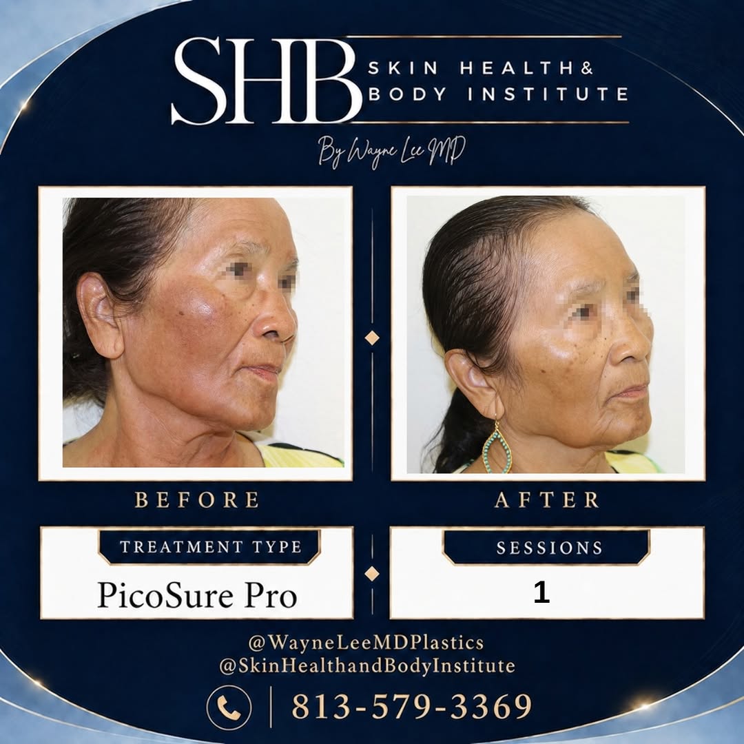 Instagram post by Dr. Wayne Lee: 🍂 FALL SKIN RESET 🍂 Refresh your skin for fall with PicoSure Pro ✨ Target unwanted pigmentation, sun damage, uneven tone, and dullness—rev…