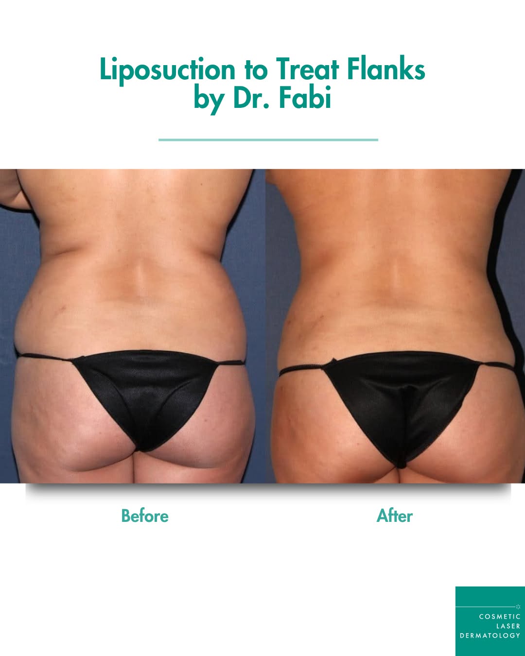 Instagram post by Dr. William Groff: 💫 Liposculpture — by Dr. Fabi This patient's results, 8 months after treatment, show what real, gradual sculpting looks like. Dr. Fabi (@sa…
