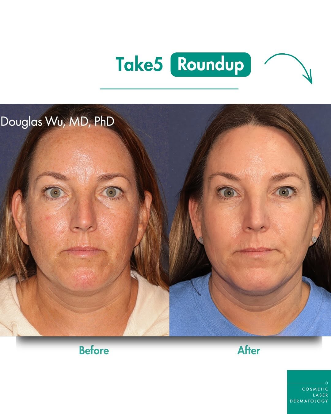 Instagram post by Dr. William Groff: 💫 Take5 Roundup: real, noticeable results — from a single session. #Take5 is our signature, non-ablative combination laser treatment, combi…