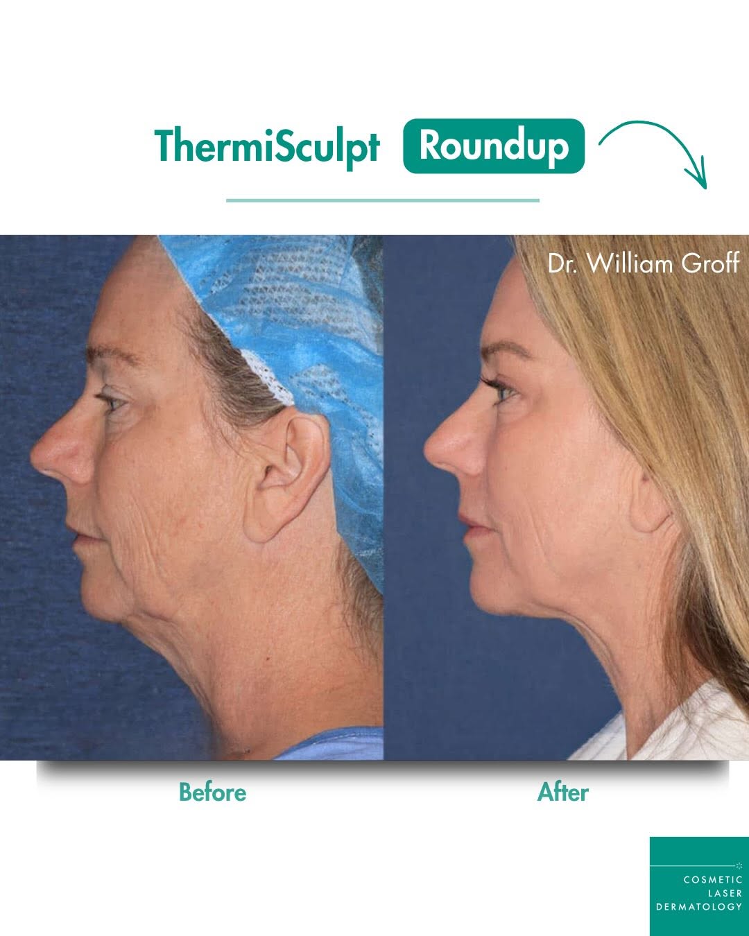 Instagram post by Dr. William Groff: 💎 Tighter skin. Less fat. A sharper jawline — in one session. Drs. Goldman and Wu helped develop ThermiTight and have published medical stu…