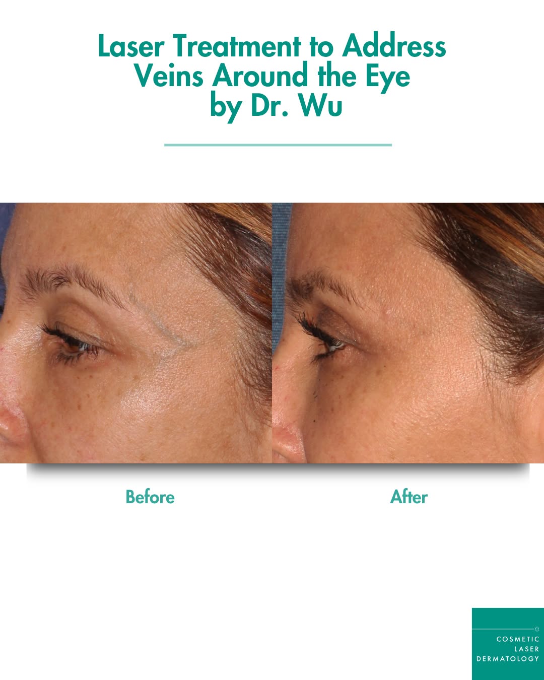 Instagram post by Dr. William Groff: 💫 Have you noticed any blue veins showing around your eyes? This is a concern many patients have, and the good news is a single laser treat…