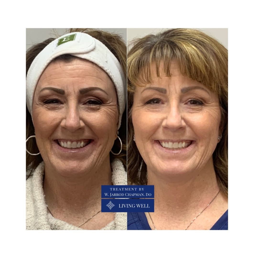 Instagram post by Dr. William Jarrod Chapman, DO: Look at the face as a whole. This is why filler isn’t simply about filling a line or adding volume to one area. As we age, changes in facial…