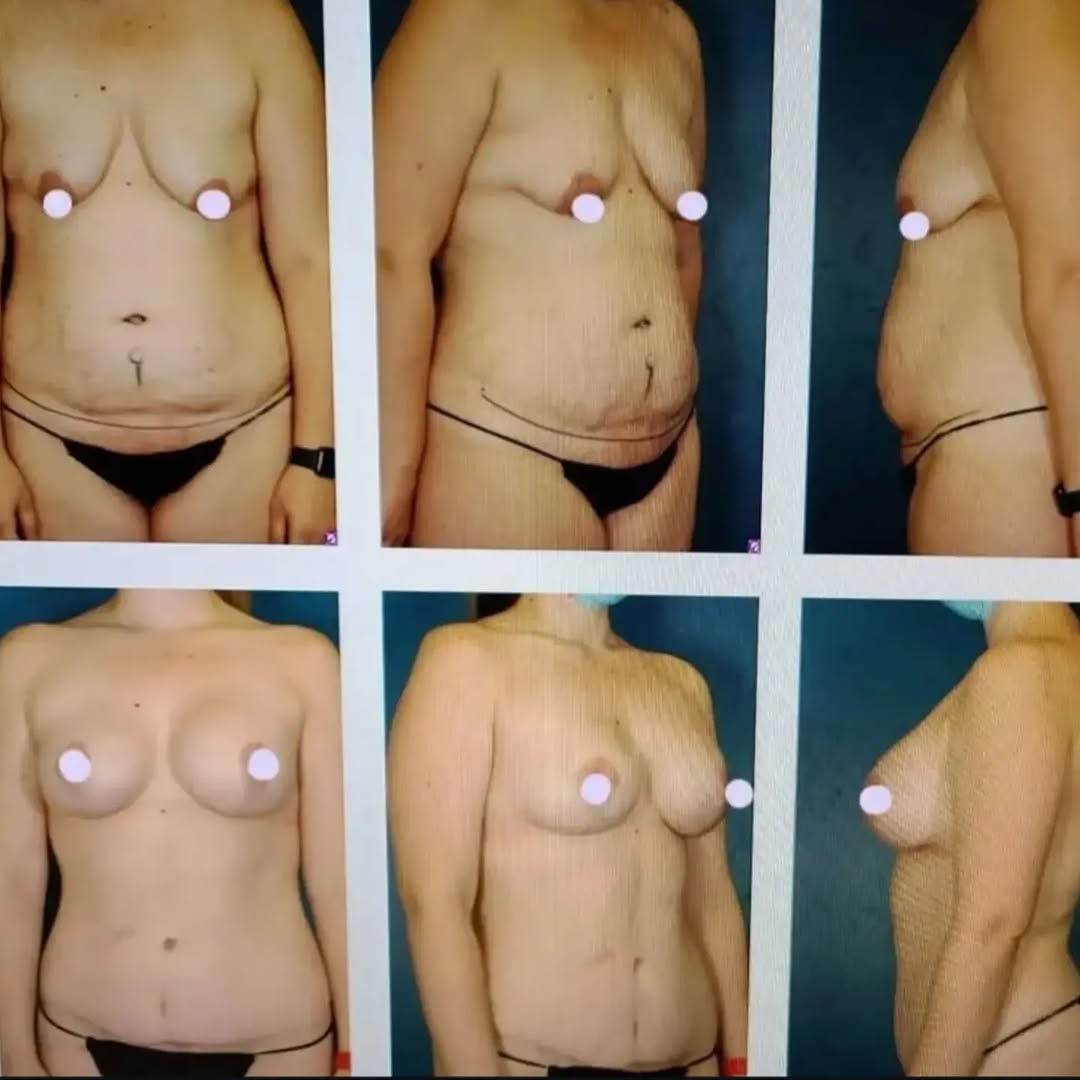 Instagram post by Dr. William Loutfy: This AMAZING patient had a Circum Vertical Mastopexy "Breast Lift" with a Breast Augmentation and an Abdominopasty "Tummy Tuck". #circumvert…