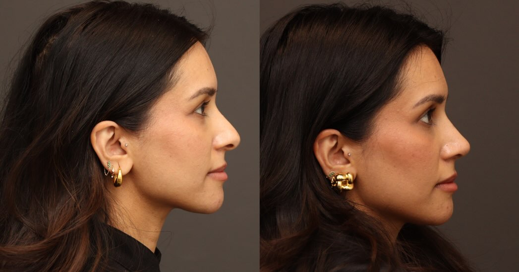 Instagram post by Dr. William Portuese: Finesse #rhinoplasty ✨ Not every rhinoplasty needs to be a dramatic transformation. Sometimes, the goal is simply to refine what’s already t…