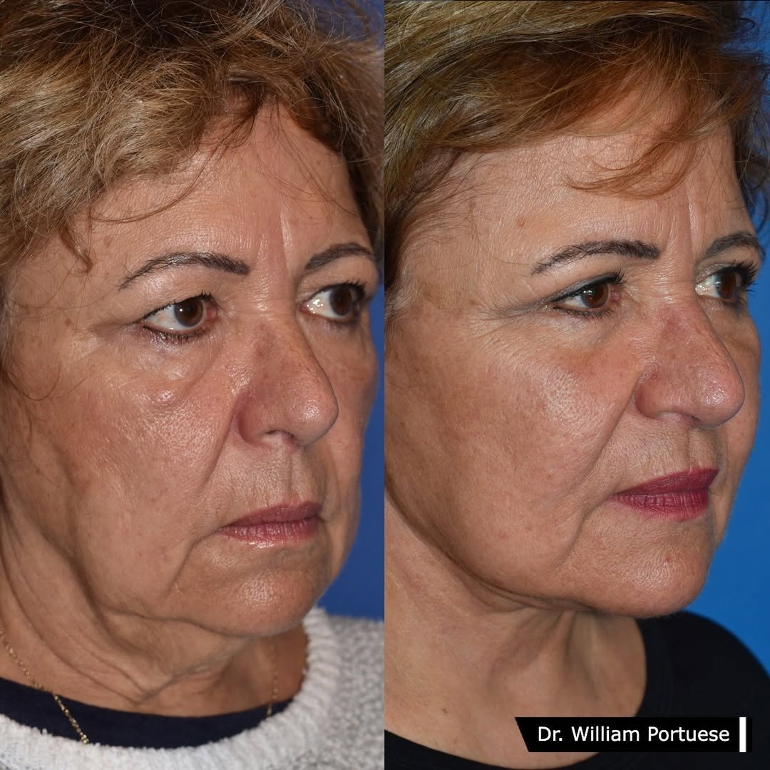 Instagram post by Dr. William Portuese: Natural facelift results that speak for themselves. 👏 . #facelift #faceliftspecialist #seattlefacialplasticsurgery . . . Dr William Portues…