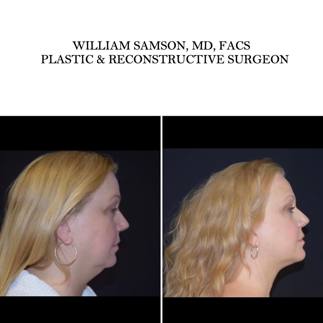 Instagram post by Dr. William Samson: In the properly selected patient, liposuction alone can yield dramatic improvements in contour and appearance of the neckline. This can be d…