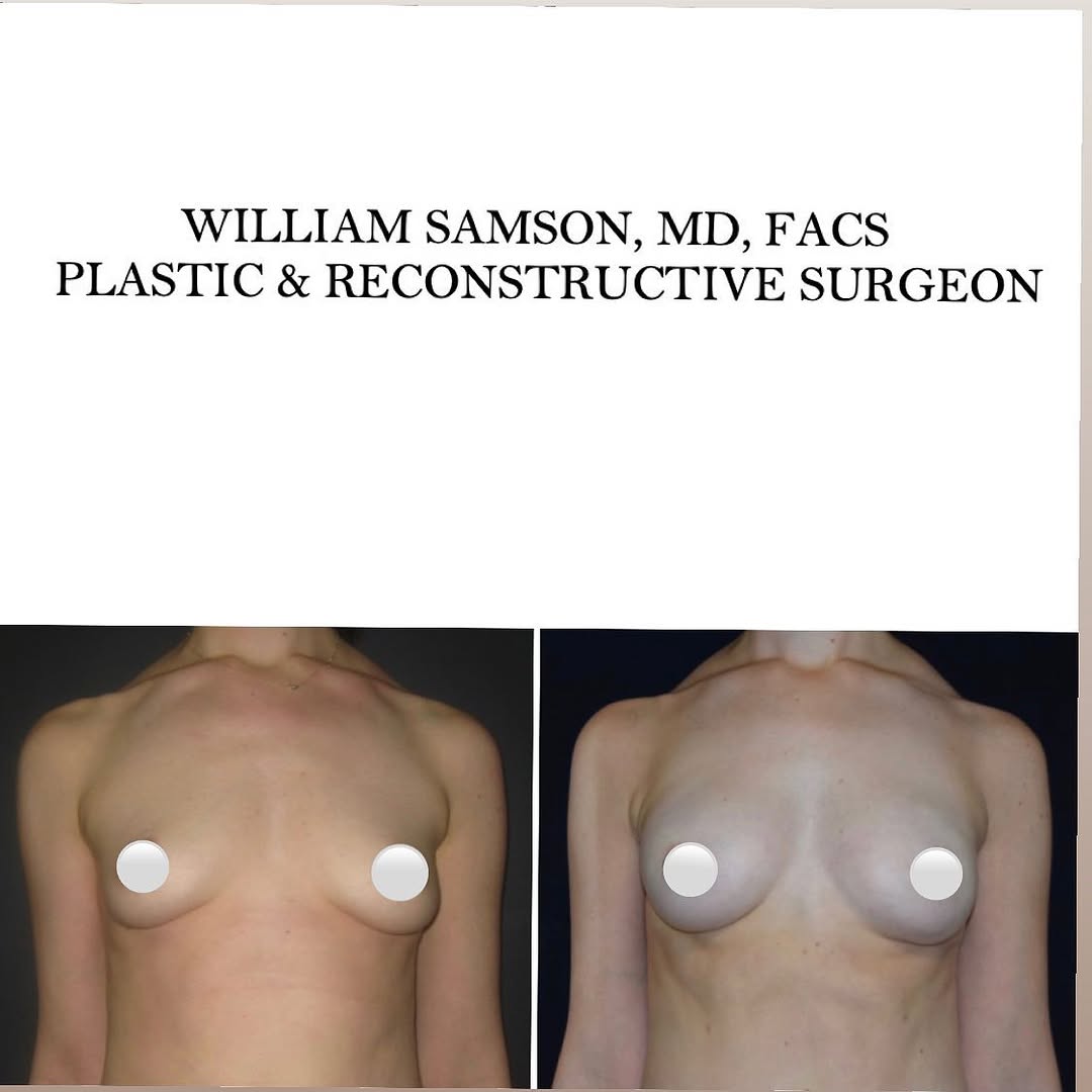 Instagram post by Dr. William Samson: Next month is breast cancer awareness month. Some high risk women make the very challenging decision to undergo prophylactic double mastecto…