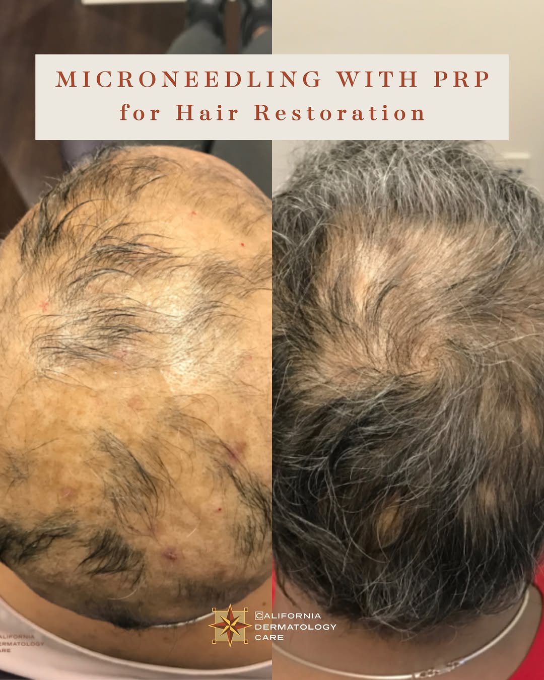 Instagram post by Dr. William Ting: Can you believe these results came from microneedling + PRP?! 👀👏 If you’re starting to notice early or mild hair thinning, this combo may …